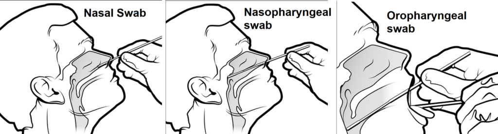Nasopharyngeal oral swab